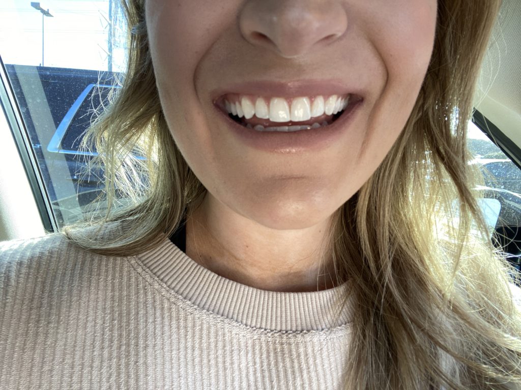 My Invisalign Experience | Audrey Madison Stowe a fashion and lifestyle blogger