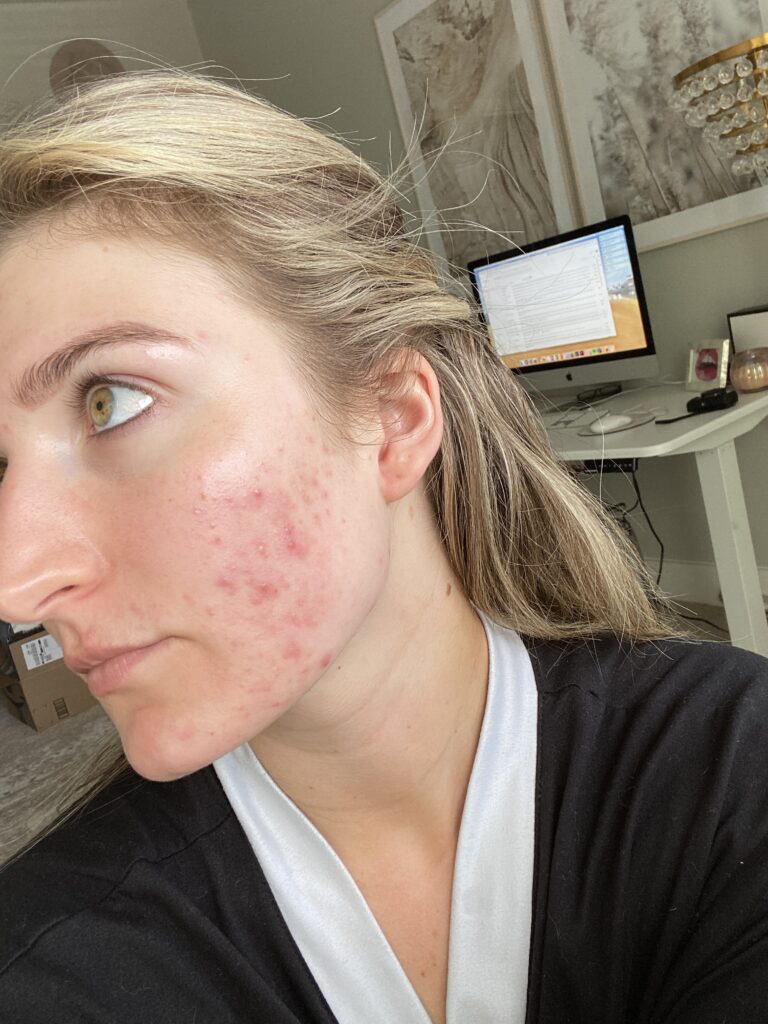 My Skin Journey with Adult Acne