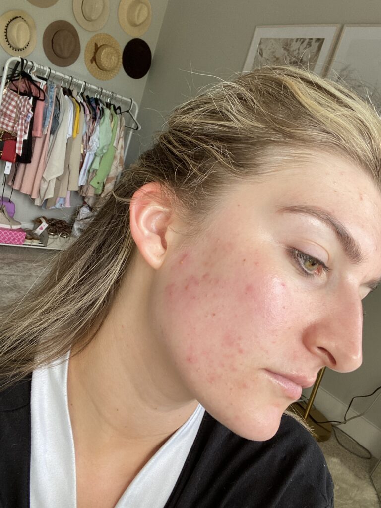 My hormonal acne battle