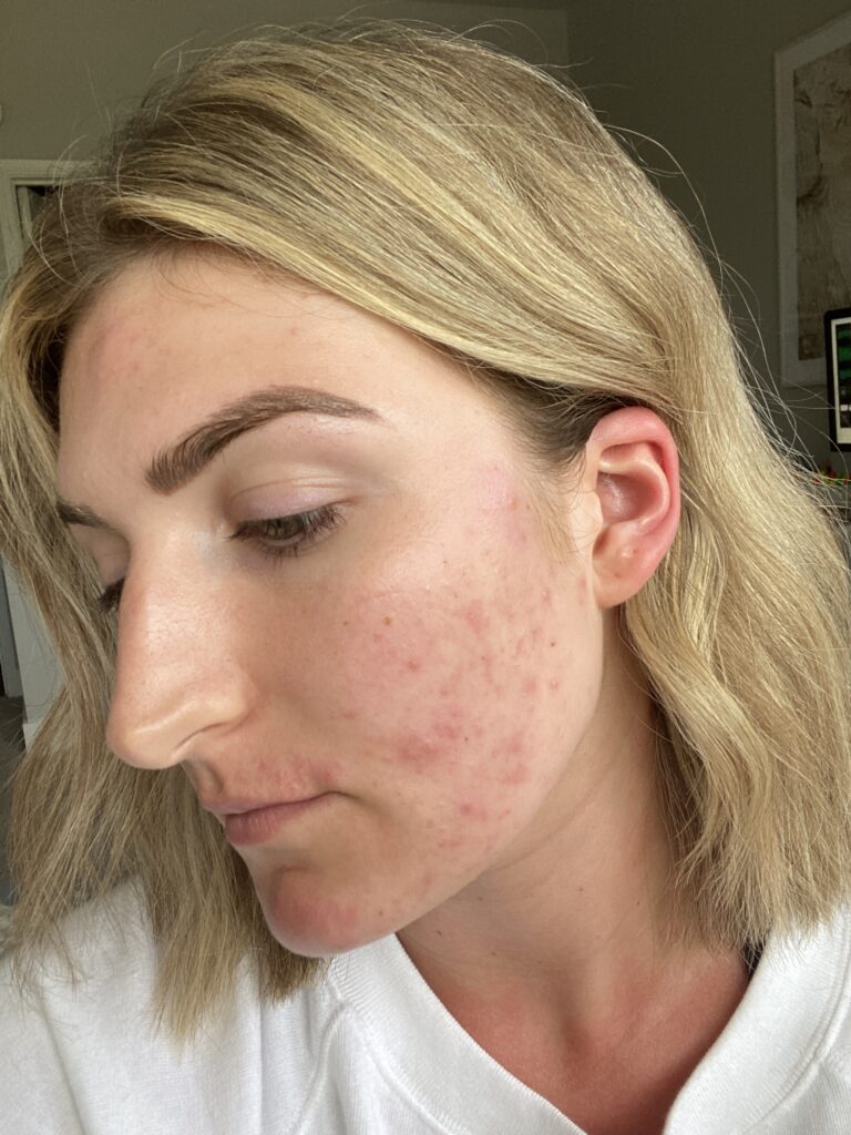 Acne getting off of birth control